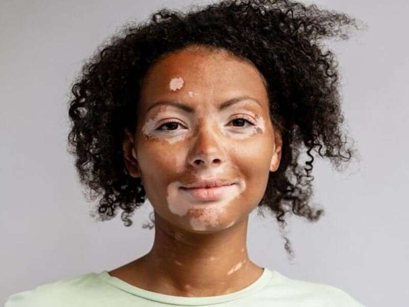 Vitiligo