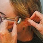 Partial hearing loss