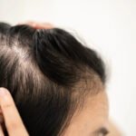 Alopecia Market